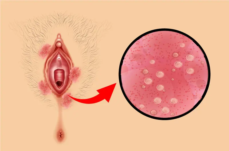 illustration des mycoses vaginales